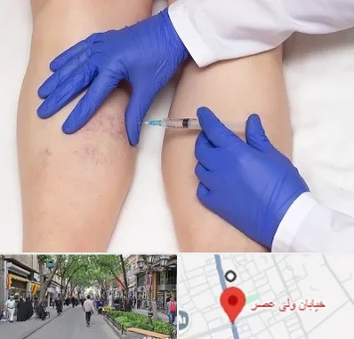 اسکلروتراپی در ولیعصر شهریار