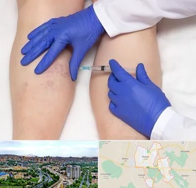 اسکلروتراپی در شهریار