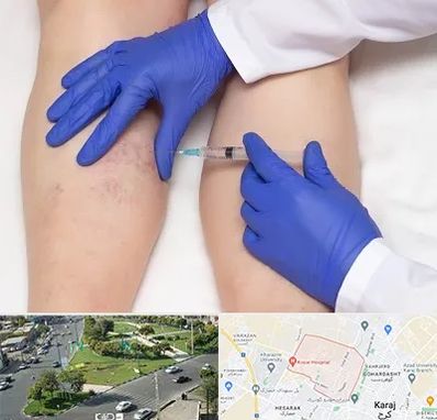 اسکلروتراپی در شاهین ویلا کرج