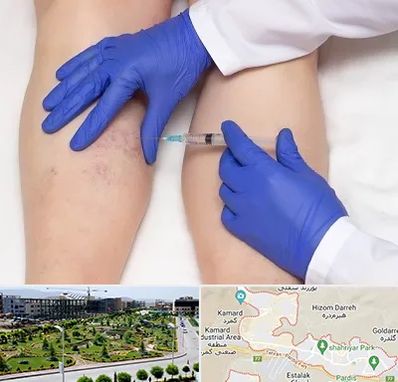 اسکلروتراپی در پردیس