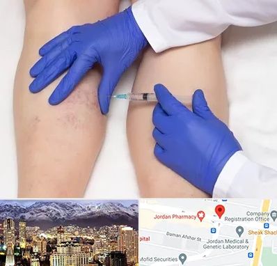 اسکلروتراپی در جردن 