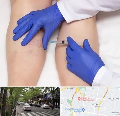 اسکلروتراپی در ظفر 