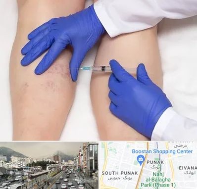 اسکلروتراپی در پونک 