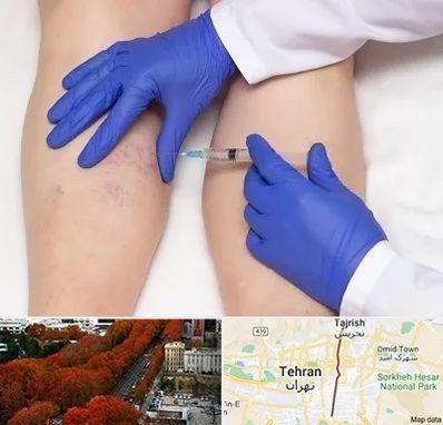 اسکلروتراپی در ولیعصر 