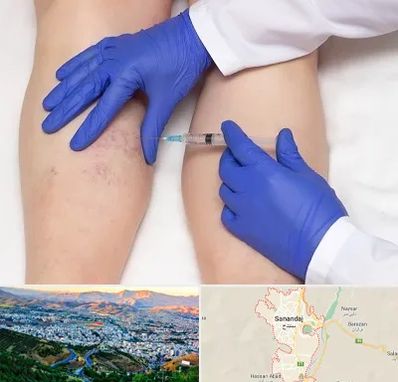 اسکلروتراپی در سنندج