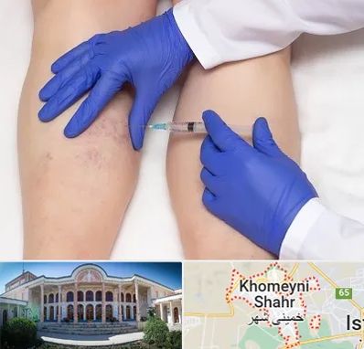 اسکلروتراپی در خمینی شهر