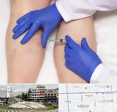 اسکلروتراپی در مرکز تهران