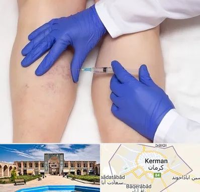 اسکلروتراپی در کرمان