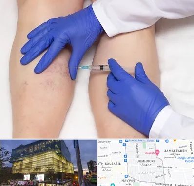 اسکلروتراپی در جمهوری 