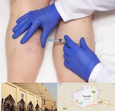 اسکلروتراپی در ساوه