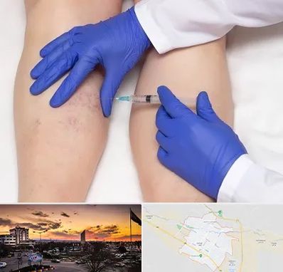 اسکلروتراپی در قوچان