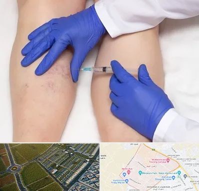 اسکلروتراپی در الهیه مشهد