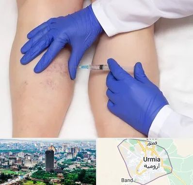 اسکلروتراپی در ارومیه