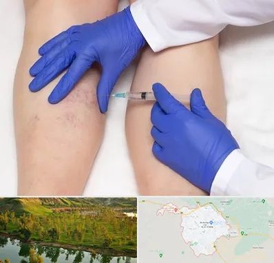 اسکلروتراپی در بهبهان