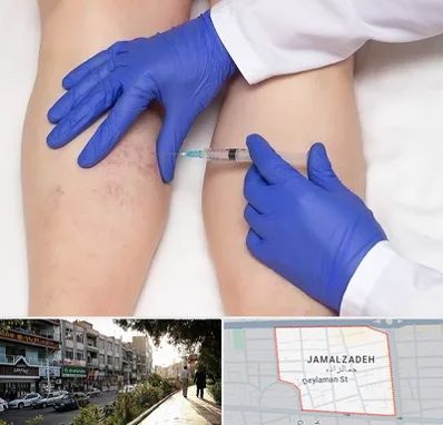 اسکلروتراپی در خیابان جمالزاده