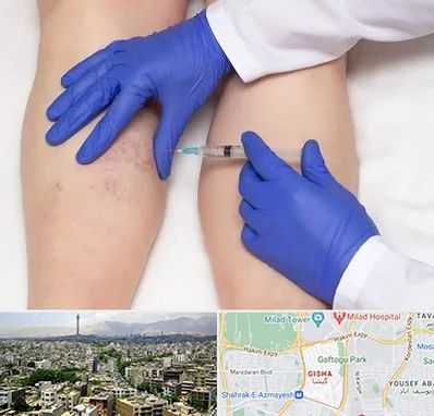 اسکلروتراپی در گیشا 