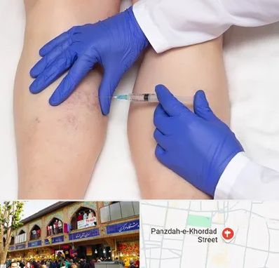 اسکلروتراپی در 15 خرداد