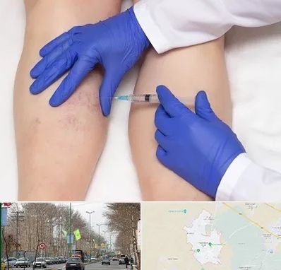 اسکلروتراپی در نظرآباد کرج 