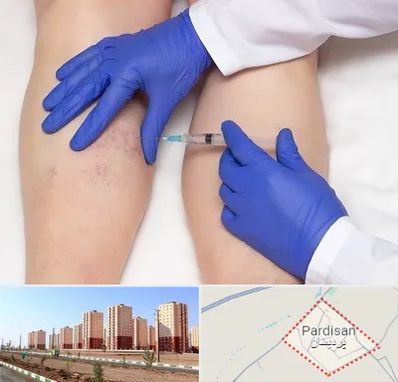 اسکلروتراپی در پردیسان قم