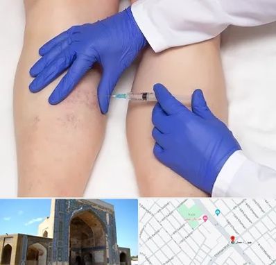 اسکلروتراپی در مصلی مشهد