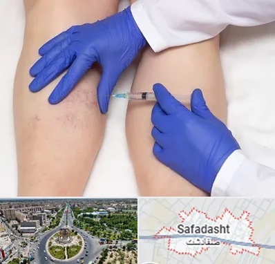 اسکلروتراپی در صفادشت