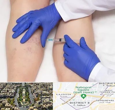 اسکلروتراپی در نارمک 