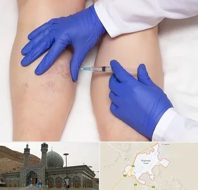 اسکلروتراپی در شهرضا