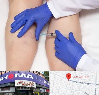 اسکلروتراپی در امین حضور