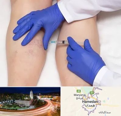 اسکلروتراپی در همدان