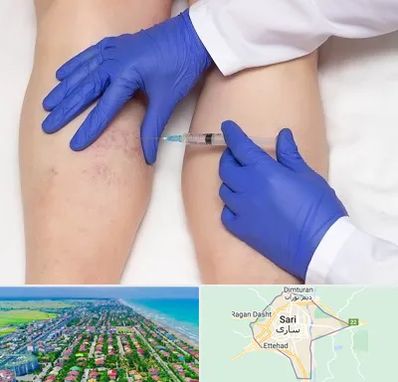 اسکلروتراپی در ساری