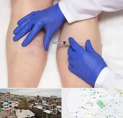 اسکلروتراپی در شمیران نو