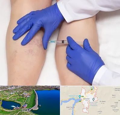 اسکلروتراپی در مهاباد