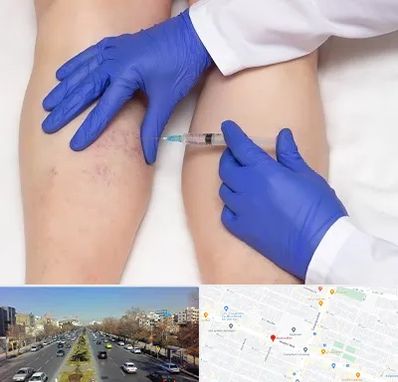 اسکلروتراپی در بلوار معلم مشهد 