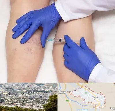 اسکلروتراپی در یاسوج