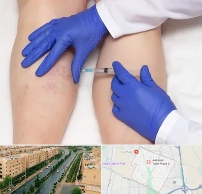 اسکلروتراپی در فاز سه اندیشه