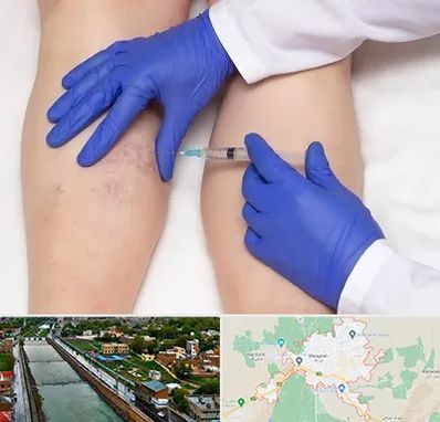 اسکلروتراپی در مراغه