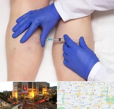 اسکلروتراپی در جنت آباد تهران 