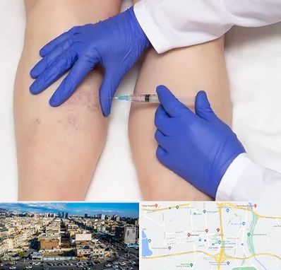 اسکلروتراپی در شهرک راه آهن