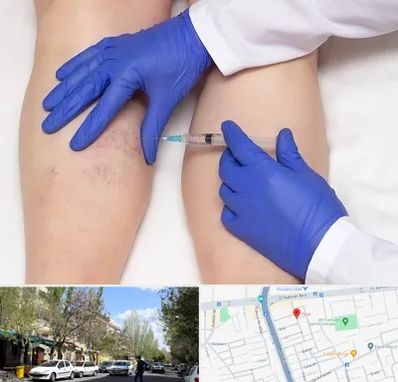 اسکلروتراپی در کوی فیروز تبریز