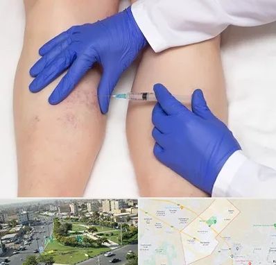 اسکلروتراپی در کمال شهر کرج 