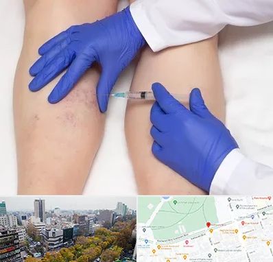 اسکلروتراپی در بلوار کشاورز 