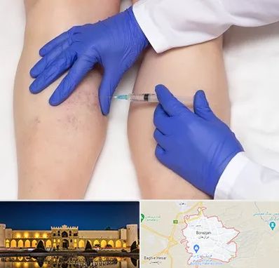 اسکلروتراپی در برازجان