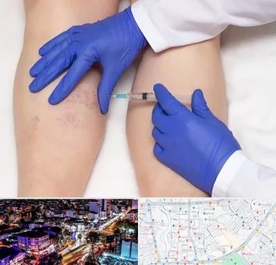 اسکلروتراپی در منظریه رشت