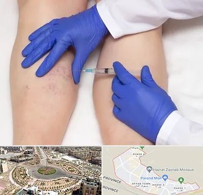 اسکلروتراپی در پرند