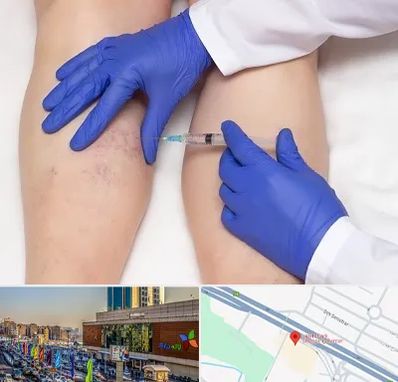 اسکلروتراپی در لاله پارک تبریز