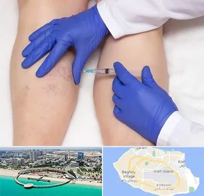 اسکلروتراپی در کیش