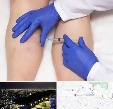 اسکلروتراپی در هفت تیر مشهد 