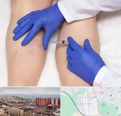 اسکلروتراپی در سهند تبریز