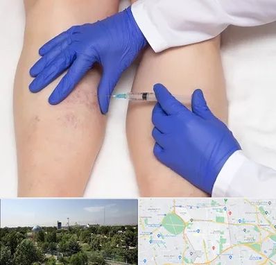 اسکلروتراپی در منطقه 16 تهران 