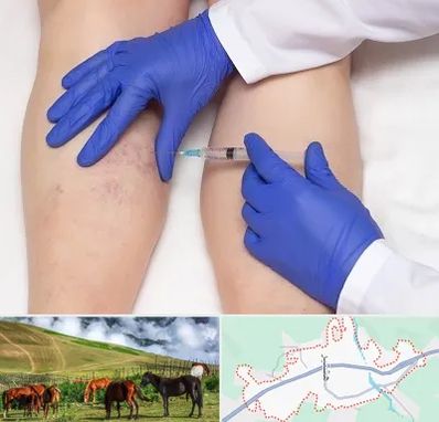 اسکلروتراپی در تالش